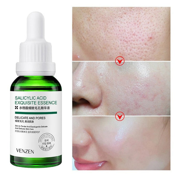 KIT ACIDO SALICILICO BIOAQUA - 5 PRODUCTOS + ENVIO GRATIS